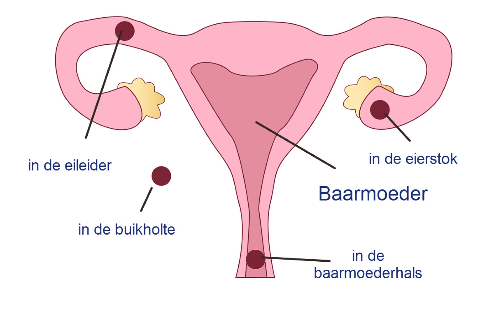 Buitenbaarmoederlijke zwangerschap - Slingeland