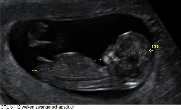 CRL bij 12 weken zwangerschapsduur